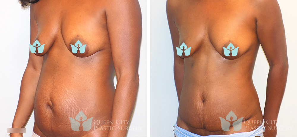 Real Patient of Dr. Enam Haque of Queen City Plastic Surgery in Charlotte, NC