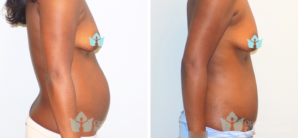 Real Patient of Dr. Enam Haque of Queen City Plastic Surgery in Charlotte, NC