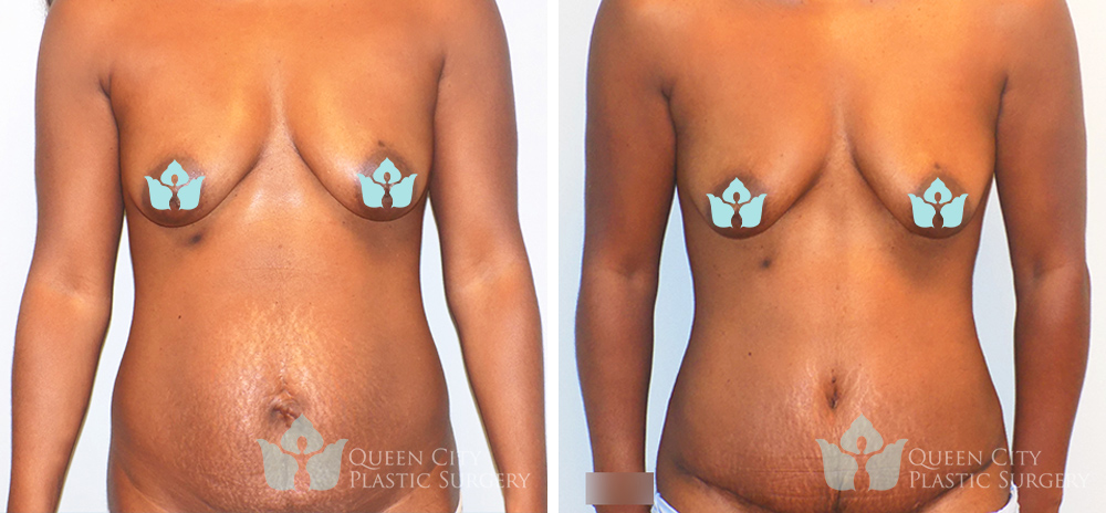 Real Patient of Dr. Enam Haque of Queen City Plastic Surgery in Charlotte, NC