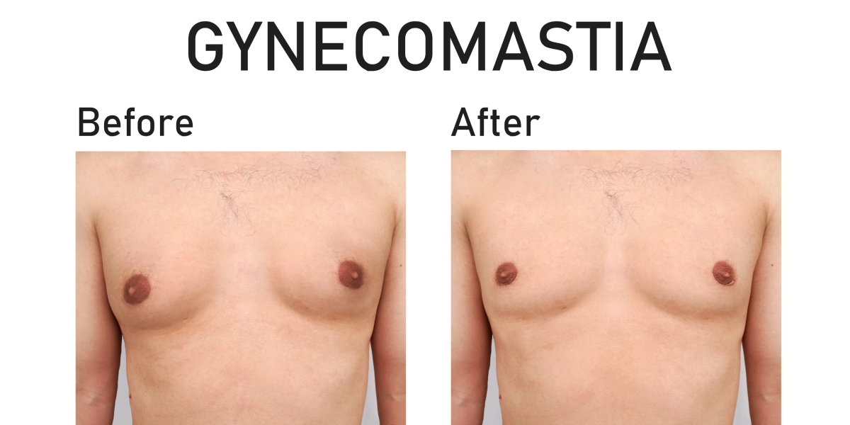 Gynecomastia