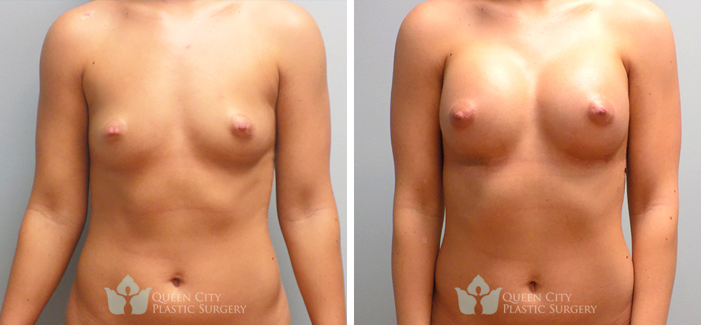 Real Patient of Dr. Enam Haque of Queen City Plastic Surgery in Charlotte, NC