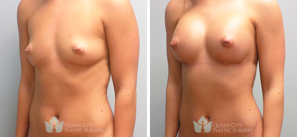 Real Patient of Dr. Enam Haque of Queen City Plastic Surgery in Charlotte, NC