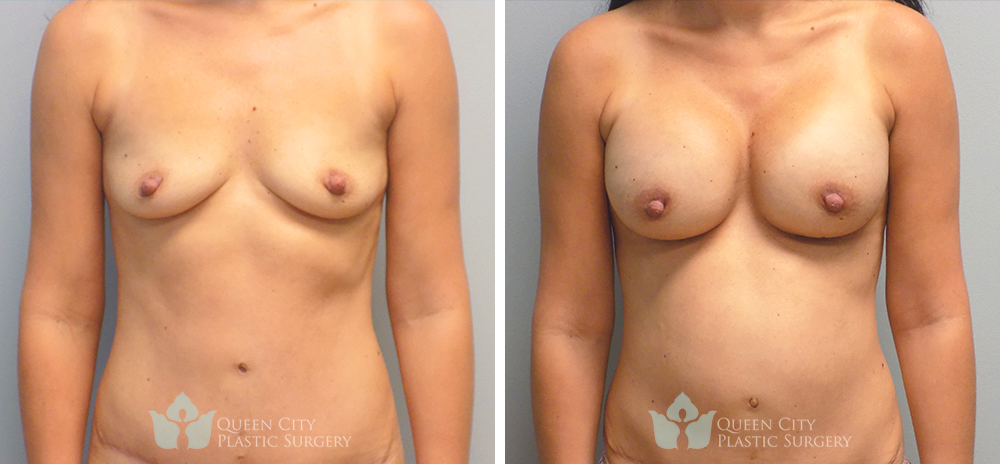 Real Patient of Dr. Enam Haque of Queen City Plastic Surgery in Charlotte, NC