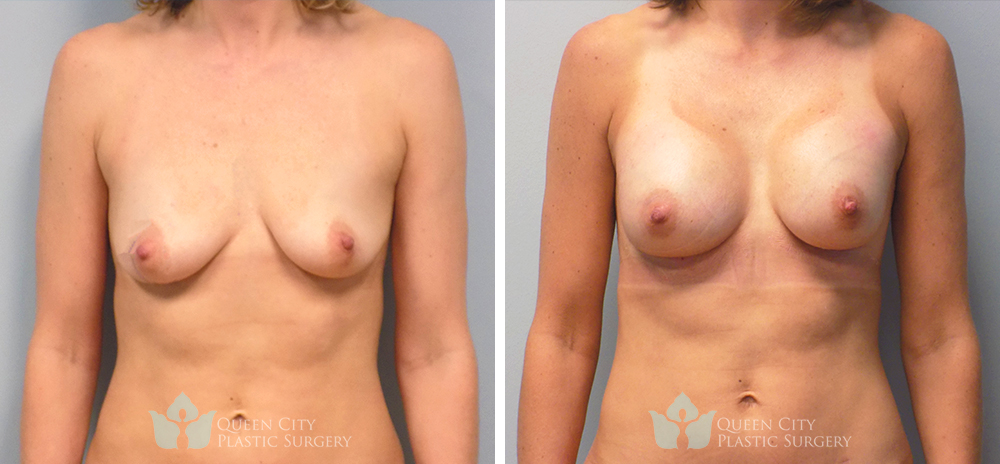 Real Patient of Dr. Enam Haque of Queen City Plastic Surgery in Charlotte, NC