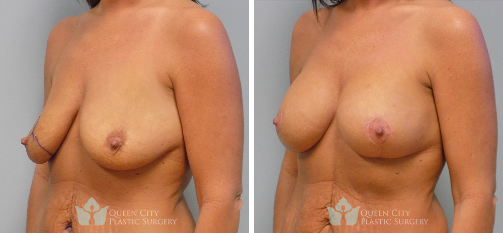 Real Patient of Dr. Enam Haque of Queen City Plastic Surgery in Charlotte, NC