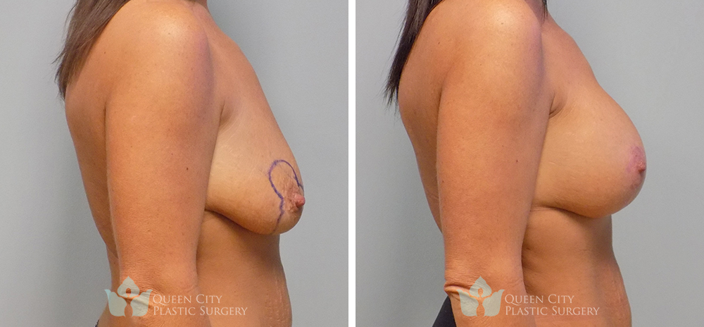 Real Patient of Dr. Enam Haque of Queen City Plastic Surgery in Charlotte, NC