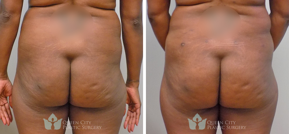 Real Patient of Dr. Enam Haque of Queen City Plastic Surgery in Charlotte, NC