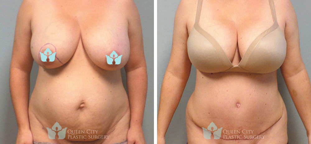 Real Patient of Dr. Enam Haque of Queen City Plastic Surgery in Charlotte, NC