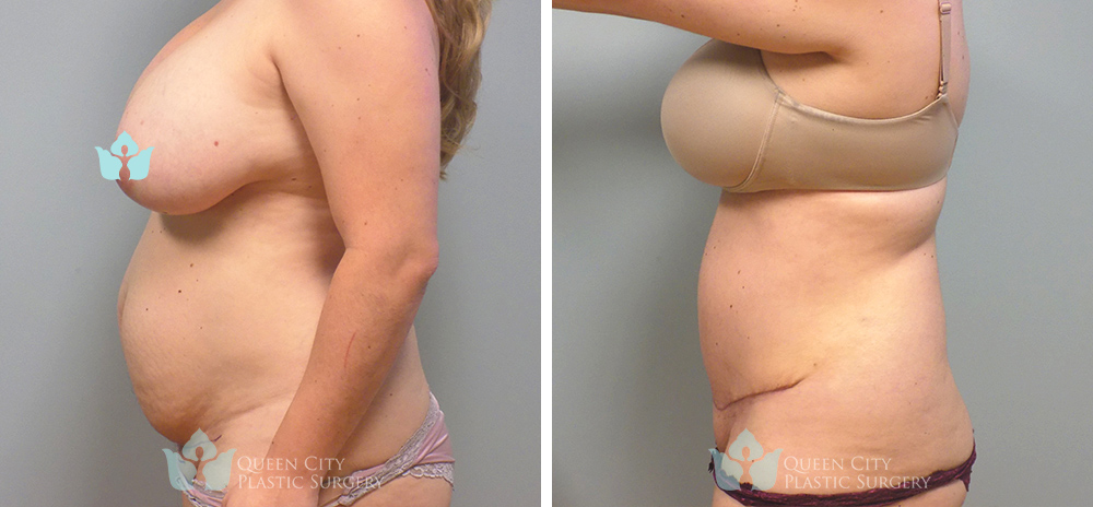 Real Patient of Dr. Enam Haque of Queen City Plastic Surgery in Charlotte, NC