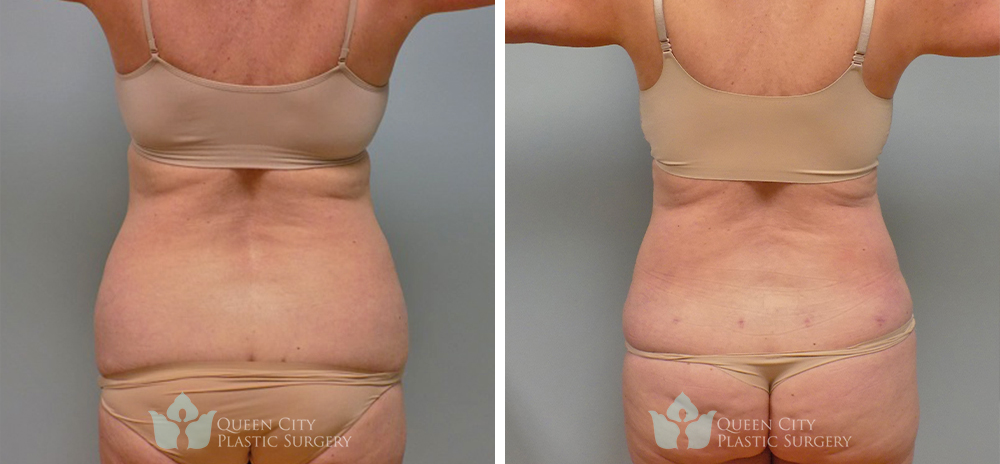 Real Patient of Dr. Enam Haque of Queen City Plastic Surgery in Charlotte, NC