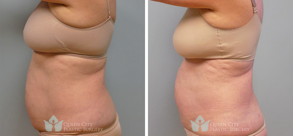 Real Patient of Dr. Enam Haque of Queen City Plastic Surgery in Charlotte, NC