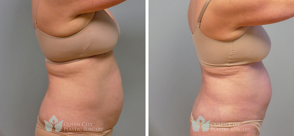 Real Patient of Dr. Enam Haque of Queen City Plastic Surgery in Charlotte, NC