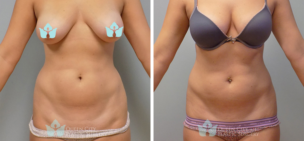 Real Patient of Dr. Enam Haque of Queen City Plastic Surgery in Charlotte, NC