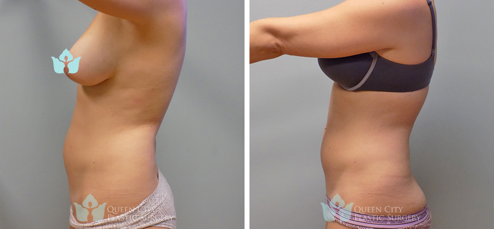 Real Patient of Dr. Enam Haque of Queen City Plastic Surgery in Charlotte, NC