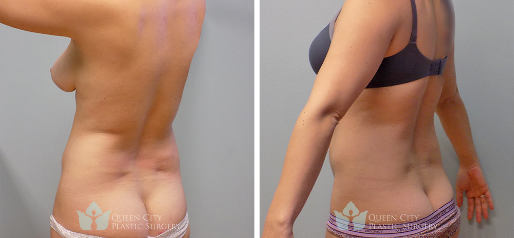 Real Patient of Dr. Enam Haque of Queen City Plastic Surgery in Charlotte, NC