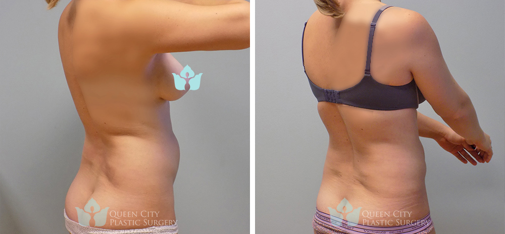 Real Patient of Dr. Enam Haque of Queen City Plastic Surgery in Charlotte, NC