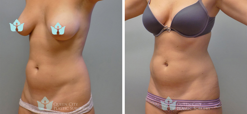 Real Patient of Dr. Enam Haque of Queen City Plastic Surgery in Charlotte, NC