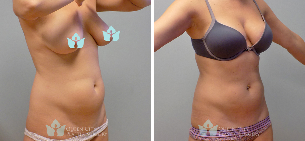 Real Patient of Dr. Enam Haque of Queen City Plastic Surgery in Charlotte, NC