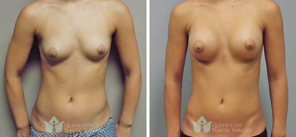 Real Patient of Dr. Enam Haque of Queen City Plastic Surgery in Charlotte, NC