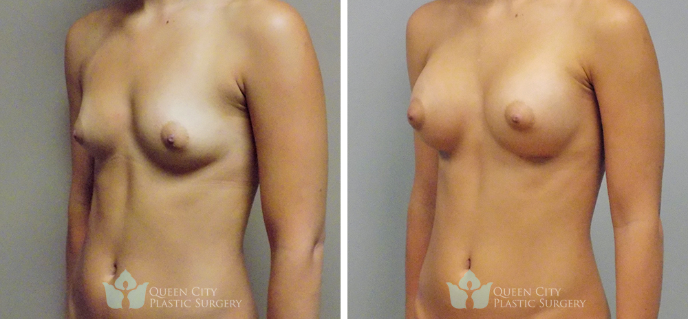 Real Patient of Dr. Enam Haque of Queen City Plastic Surgery in Charlotte, NC