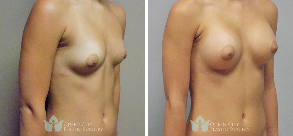 Real Patient of Dr. Enam Haque of Queen City Plastic Surgery in Charlotte, NC