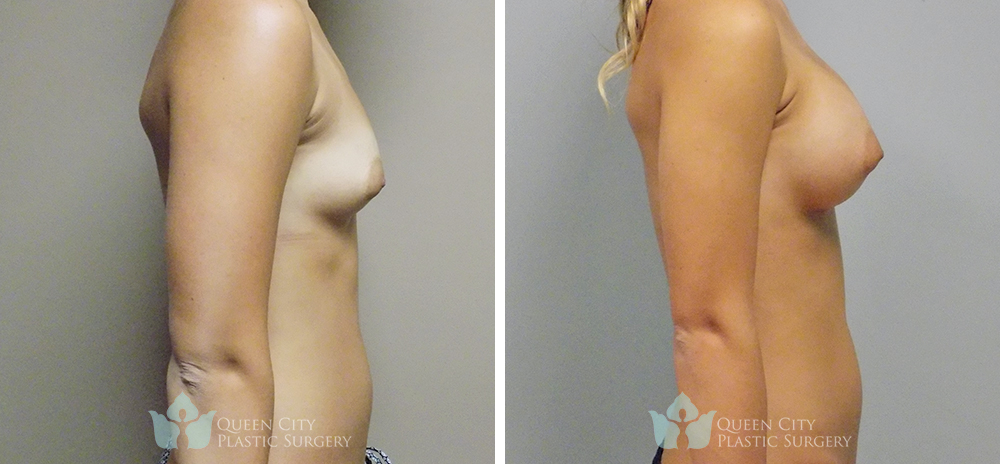 Real Patient of Dr. Enam Haque of Queen City Plastic Surgery in Charlotte, NC