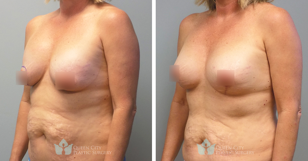 Real Patient of Dr. Enam Haque of Queen City Plastic Surgery in Charlotte, NC