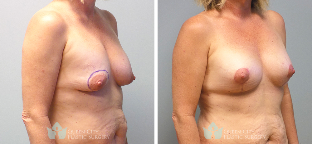 Real Patient of Dr. Enam Haque of Queen City Plastic Surgery in Charlotte, NC