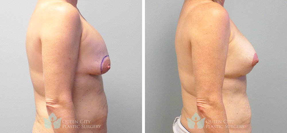 Real Patient of Dr. Enam Haque of Queen City Plastic Surgery in Charlotte, NC