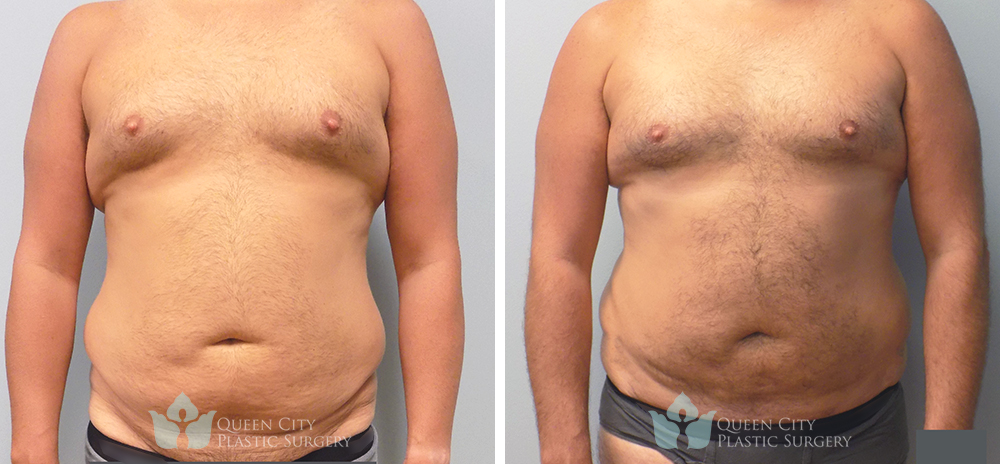 Real Patient of Dr. Enam Haque of Queen City Plastic Surgery in Charlotte, NC