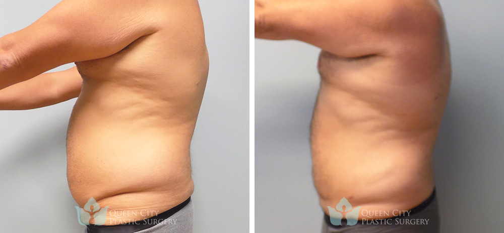 Real Patient of Dr. Enam Haque of Queen City Plastic Surgery in Charlotte, NC