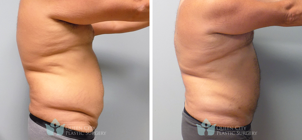 Real Patient of Dr. Enam Haque of Queen City Plastic Surgery in Charlotte, NC