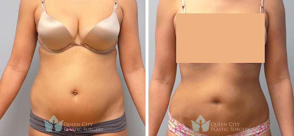 Real Patient of Dr. Enam Haque of Queen City Plastic Surgery in Charlotte, NC