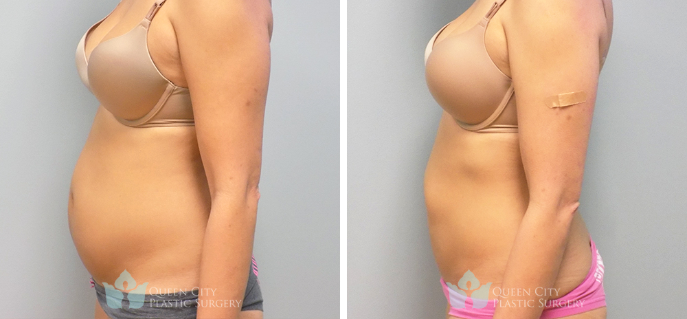 Real Patient of Dr. Enam Haque of Queen City Plastic Surgery in Charlotte, NC