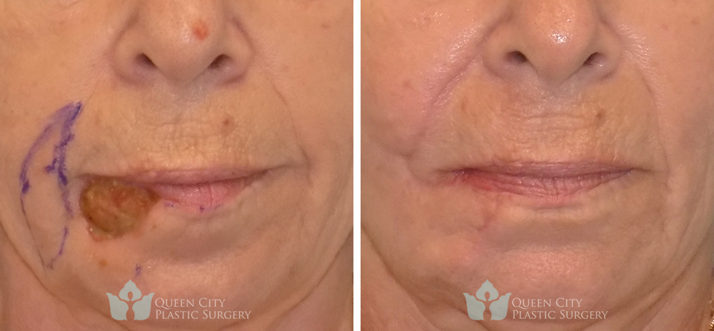 Real Patient of Dr. Enam Haque of Queen City Plastic Surgery in Charlotte, NC