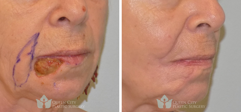 Real Patient of Dr. Enam Haque of Queen City Plastic Surgery in Charlotte, NC