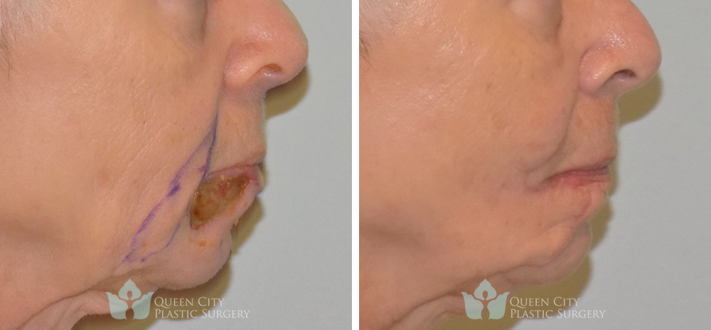 Real Patient of Dr. Enam Haque of Queen City Plastic Surgery in Charlotte, NC