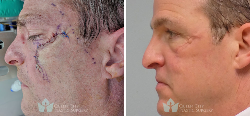 Real Patient of Dr. Enam Haque of Queen City Plastic Surgery in Charlotte, NC