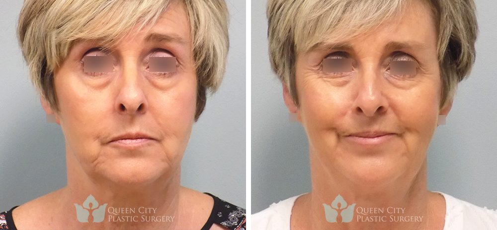 Real Patient of Dr. Enam Haque of Queen City Plastic Surgery in Charlotte, NC