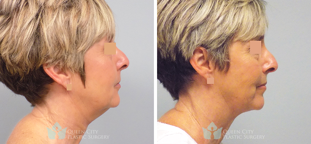 Real Patient of Dr. Enam Haque of Queen City Plastic Surgery in Charlotte, NC