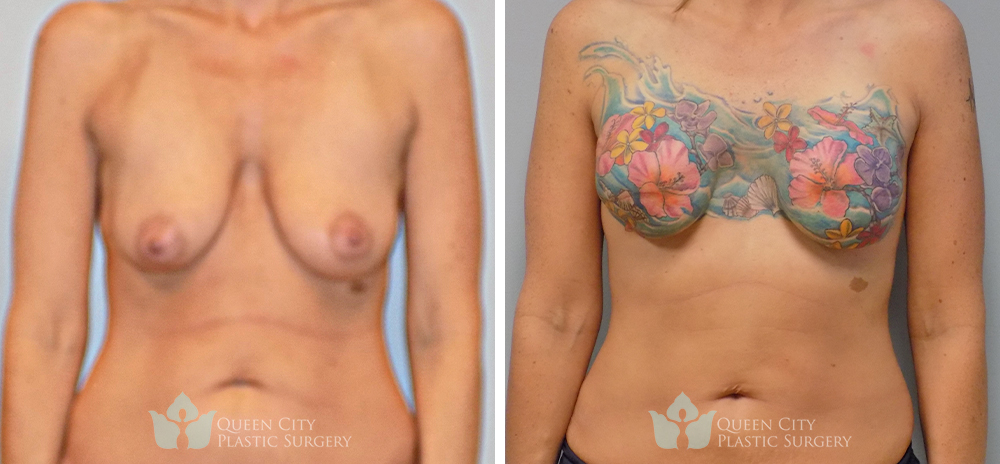 Real Patient of Dr. Enam Haque of Queen City Plastic Surgery in Charlotte, NC