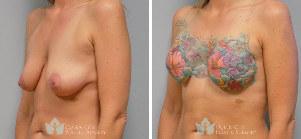 Real Patient of Dr. Enam Haque of Queen City Plastic Surgery in Charlotte, NC