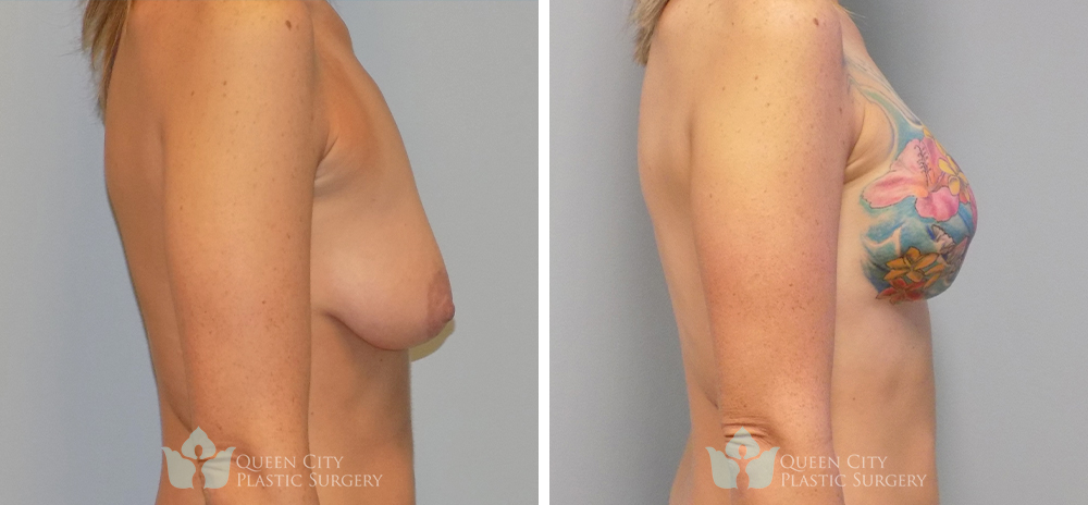 Real Patient of Dr. Enam Haque of Queen City Plastic Surgery in Charlotte, NC