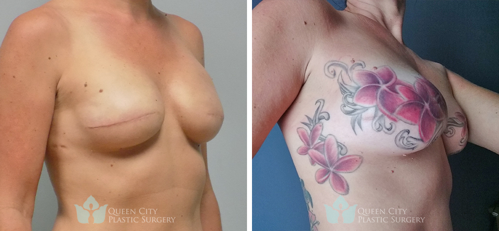 Real Patient of Dr. Enam Haque of Queen City Plastic Surgery in Charlotte, NC