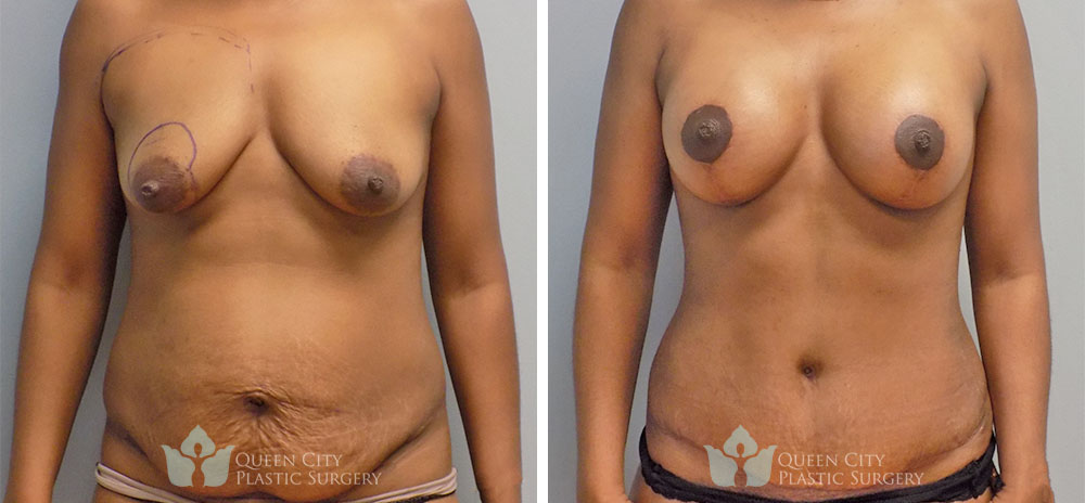 Real Patient of Dr. Enam Haque of Queen City Plastic Surgery in Charlotte, NC