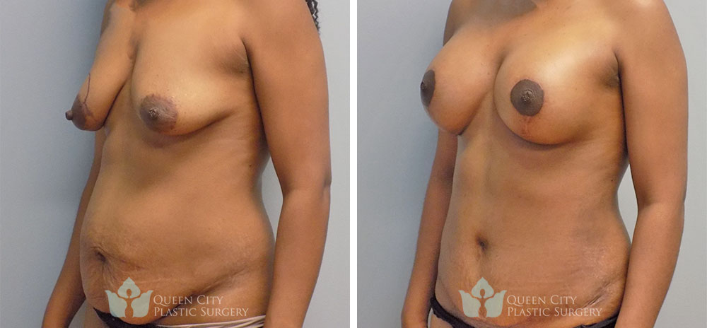 Real Patient of Dr. Enam Haque of Queen City Plastic Surgery in Charlotte, NC