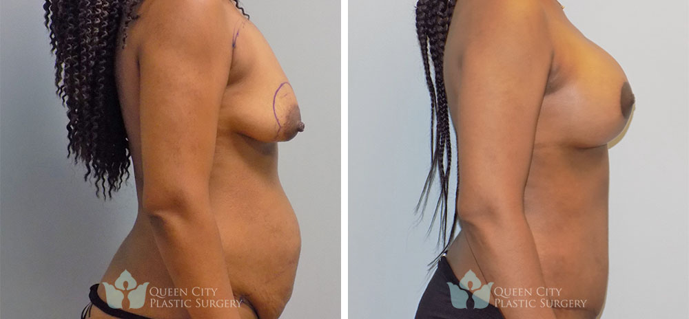 Real Patient of Dr. Enam Haque of Queen City Plastic Surgery in Charlotte, NC