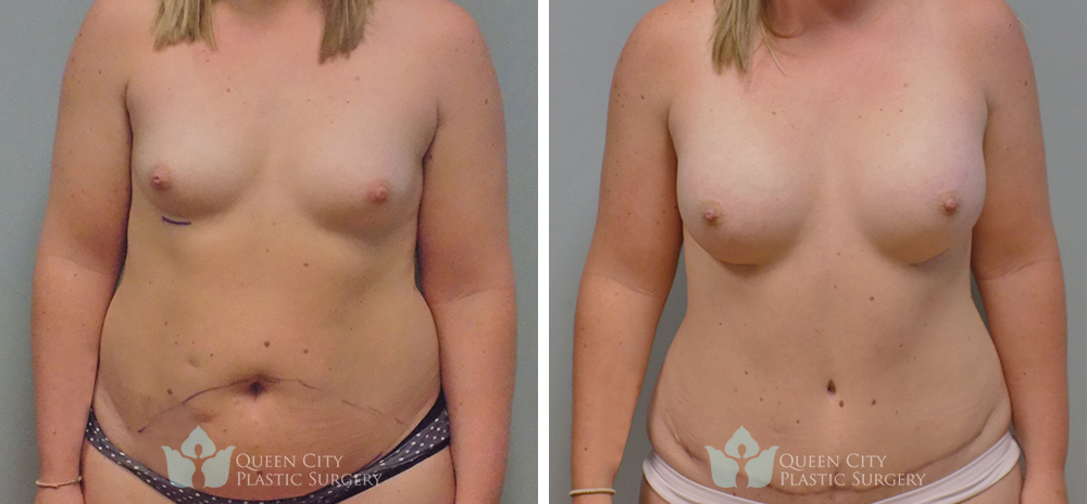 Real Patient of Dr. Enam Haque of Queen City Plastic Surgery in Charlotte, NC