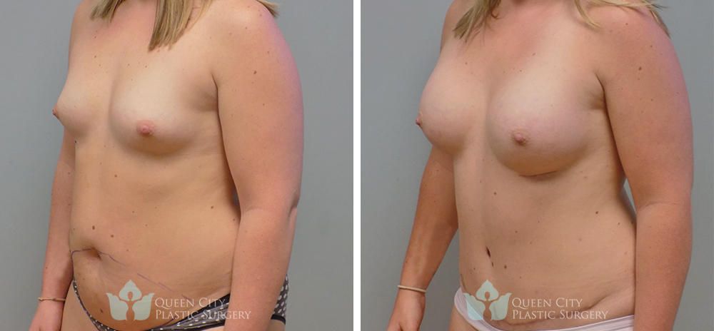 Real Patient of Dr. Enam Haque of Queen City Plastic Surgery in Charlotte, NC