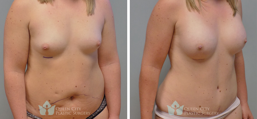 Real Patient of Dr. Enam Haque of Queen City Plastic Surgery in Charlotte, NC